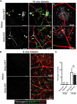 Fractalkine Signaling Attenuates Perivascular Clustering of Microglia and Fibrinogen Leakage during Systemic Inflammation in Mouse Models of Diabetic Retinopathy